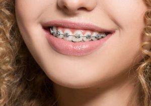 braces